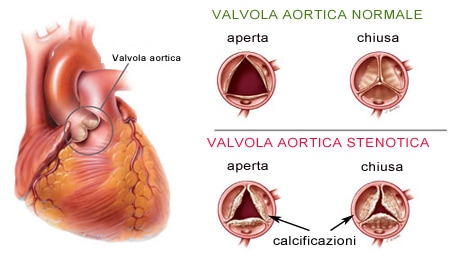 stenosi aortica