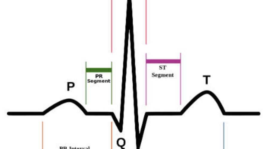 Come riconoscere una tachicardia ventricolare all’elettrocardiogramma?