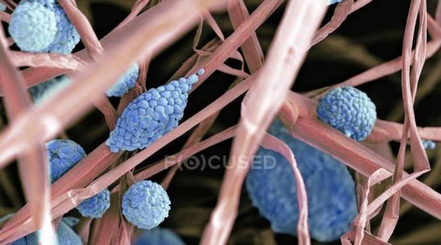 Cellule fungine scoperte in 35 tipi di cancro