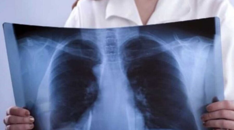 Istoplasmosi polmonare, quali sono i rischi?