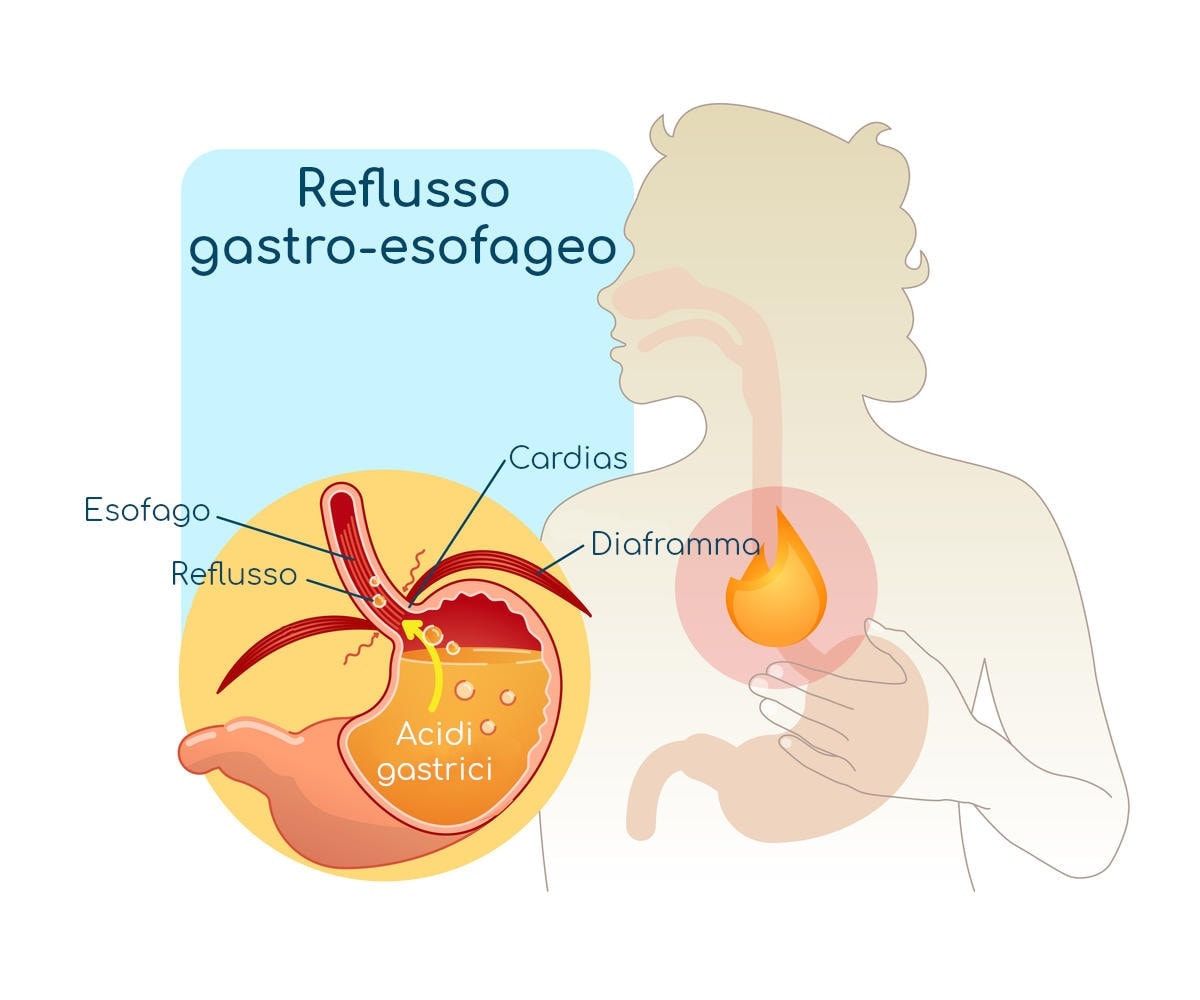 Anatomia semplificata degli organi coinvolti nel reflusso gastroesofageo