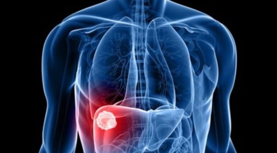 Epatocarcinoma: sintomi, diagnosi e trattamento del cancro al fegato