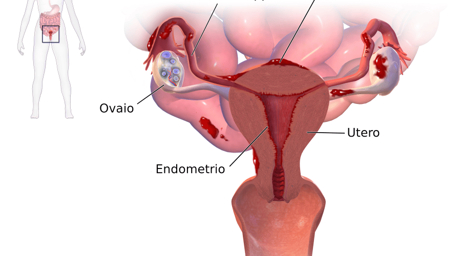 Endometriosi, ecco com’è la vita di chi ne soffre