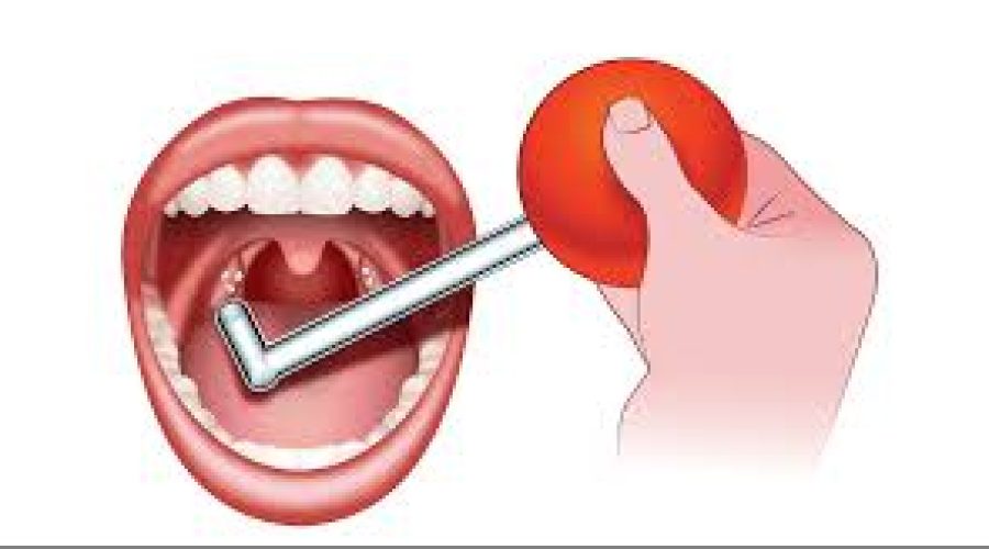 Tonsilloliti, i calcoli delle tonsille