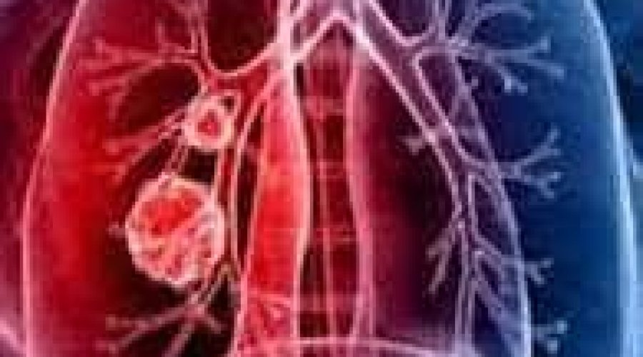 Fibrosi polmonare: al via un’indagine su aspettative e convinzioni dei pazienti