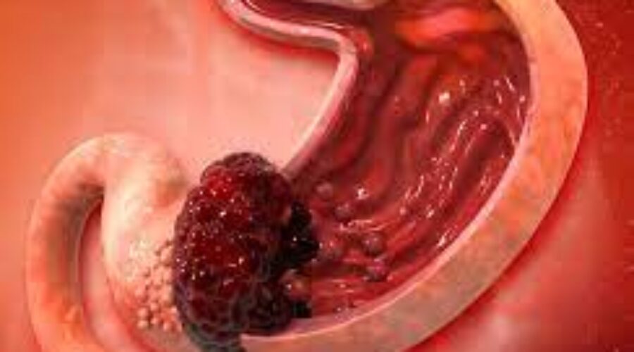 Epidemiologia e classificazione del tumore gastrico