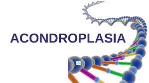 Acondroplasia