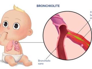 BRONCHIOLITE