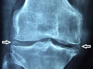 Chondrocalcinosis_-_annotated-540×462-1