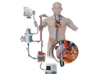 ECMO-Fig_cropped