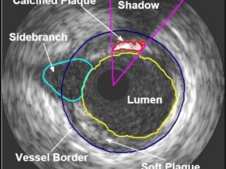 IVUS-immagine