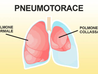 PNEUMOTORACE-article-thumbnail-size