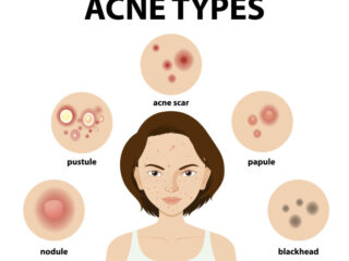 acne