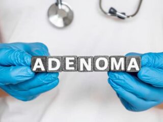 adenoma-700×462-1