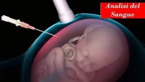 amniocentesi