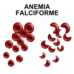 anemiafalciforme