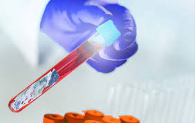 biopsia