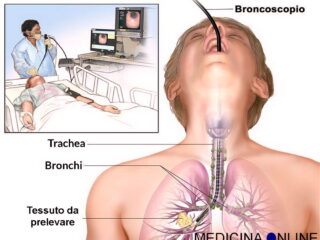 broncoscopia