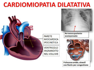 cardiomiopatia-dilatativa-cuore-a-fiasca