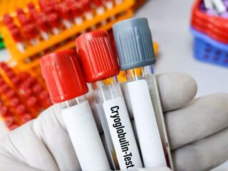 crioglobulinemia-700×462-1