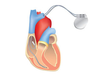 cuore-pacemaker-360