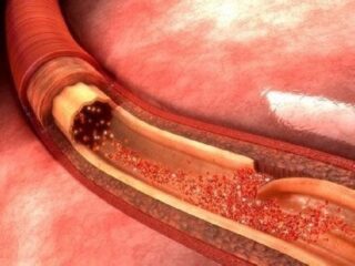 dissecazione-aortica-conosciamola-meglio