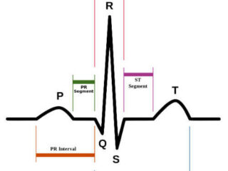 ecg-sinusale2-500×462-1
