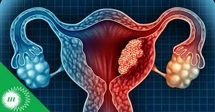 endometrio