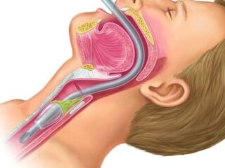 endotracheal-intubation-812×462-1