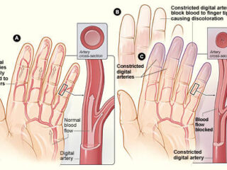 fenomeno-di-raynaud