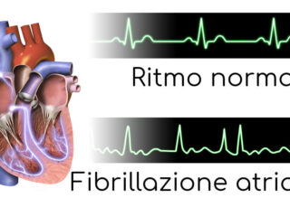 fibrillazione-atriale-esempio-1