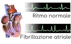 fibrillazione-atriale