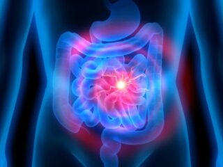 infarto-intestinale-700×462-1