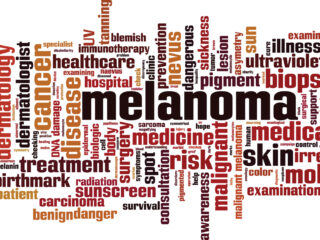 melanoma