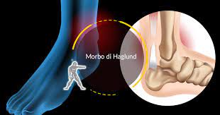 morbo-a