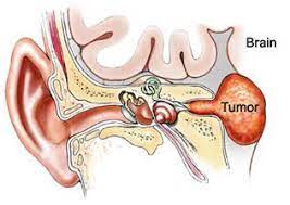 neurinoma
