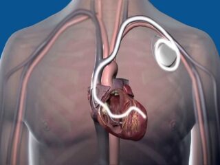 pacemaker