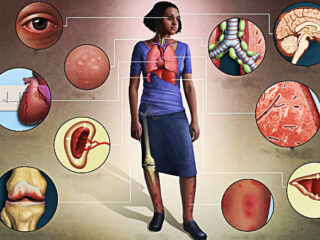 sarcoidosi-che-cose-sintomi-cause-diagnosi-e-possibili-cure