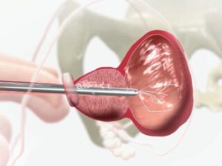 stent-prostatico-700×462-1