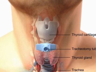 tracheotomia-704×462-1