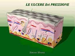 ulcere