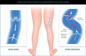 vene