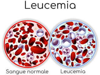 leucemia